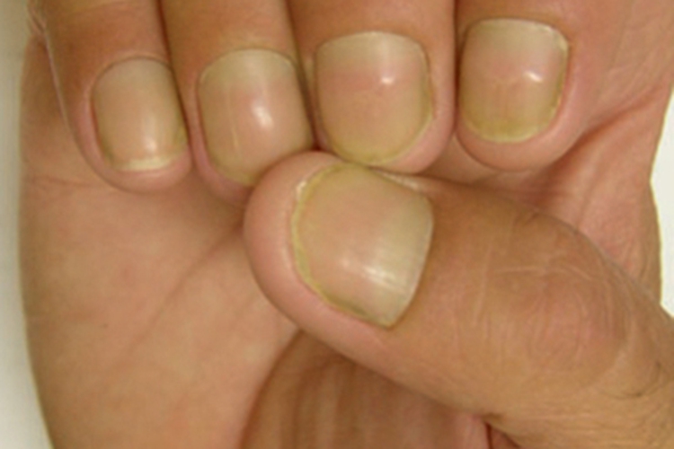 黄甲综合征手指甲症状图