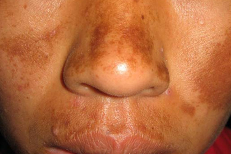 瑞尔黑变病面部结痂图