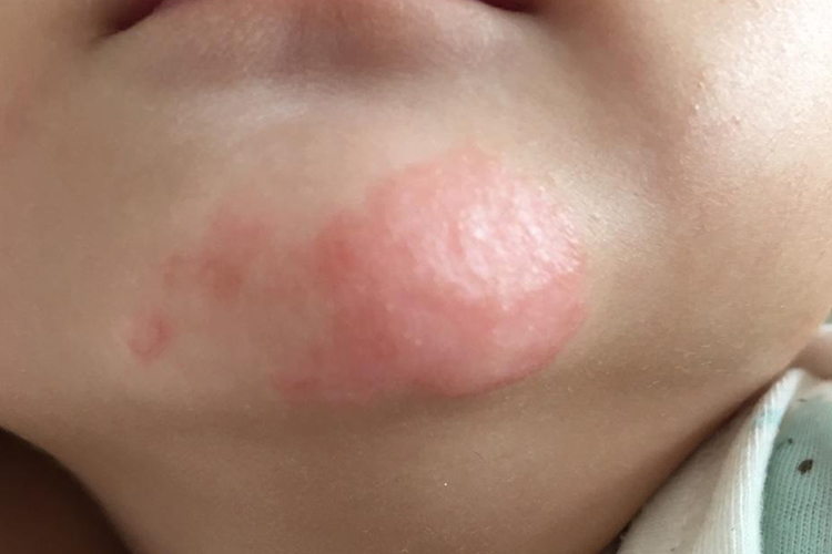 婴儿下巴接触性皮炎图
