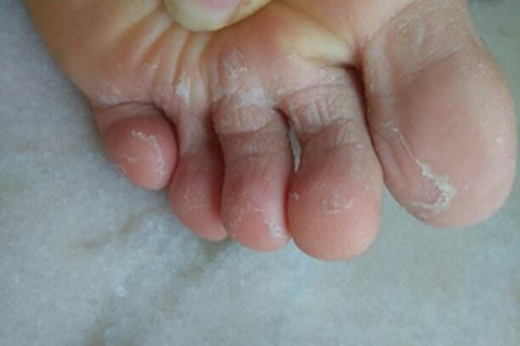 脚趾长水疱破了起皮图