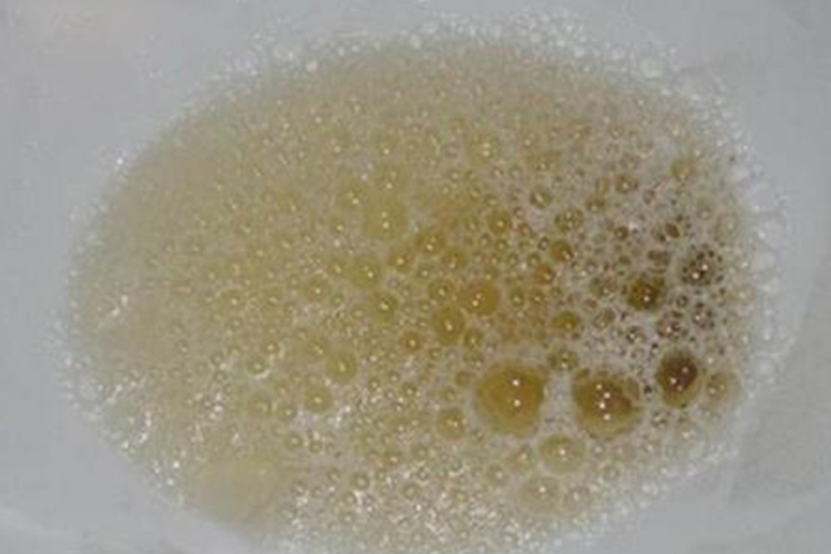 肾功能不好导致尿中泡沫增多图