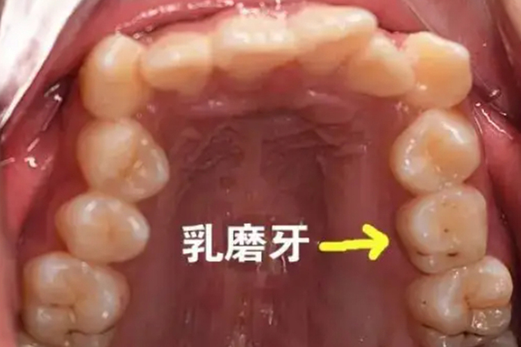 乳磨牙图