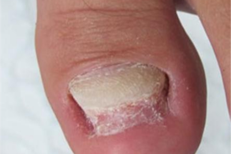 银屑病甲缺损图