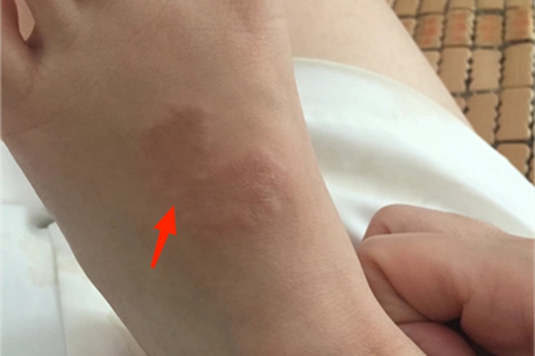 环状肉芽肿脚背疙瘩图