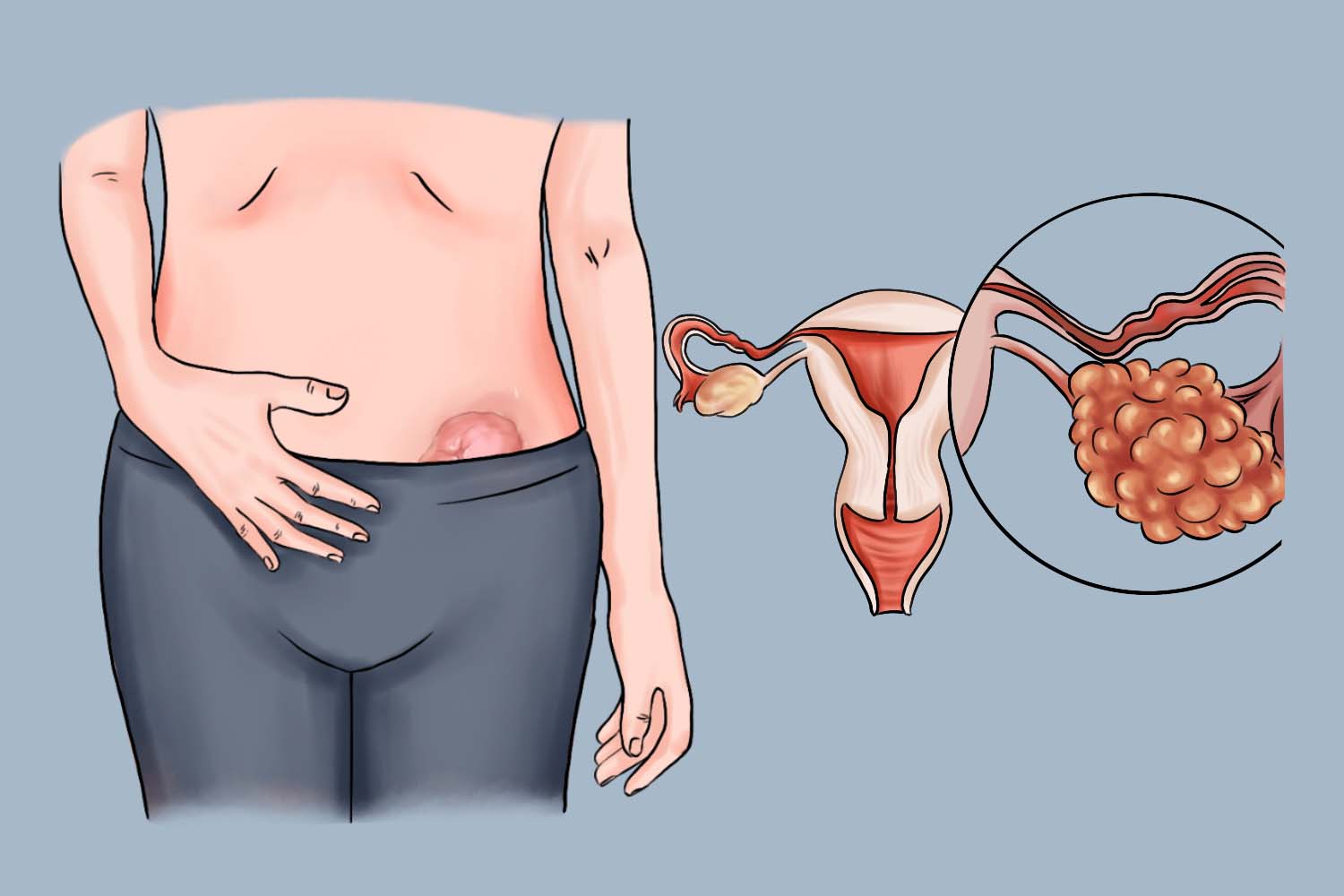 卵巢癌腹部包块图 卵巢癌腹部包块图