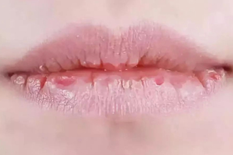 维生素A过多症皲裂图