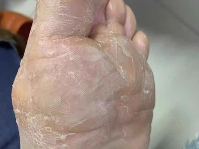 鳞屑角化型足癣脚底皮肤发白脱屑图.jpeg