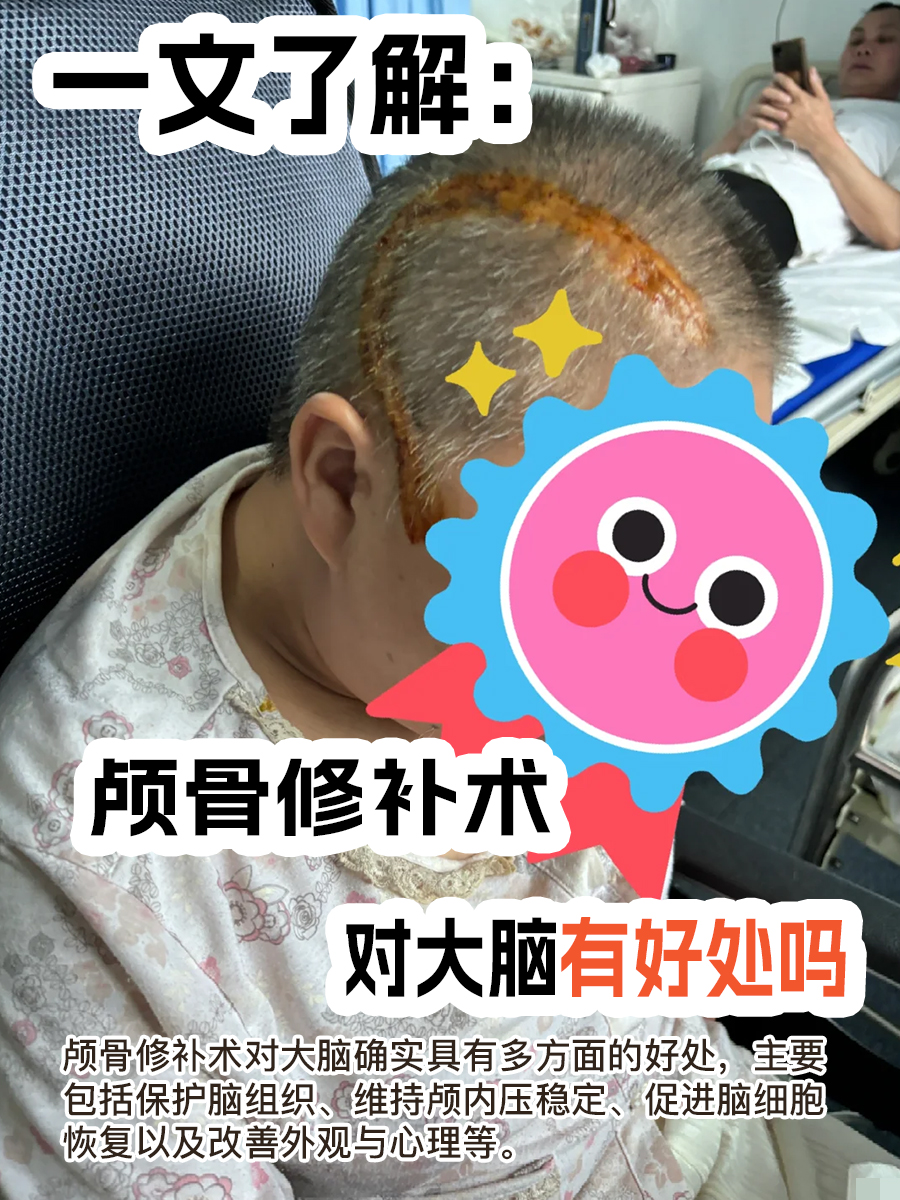 一文了解:颅骨修补术对大脑有好处吗
