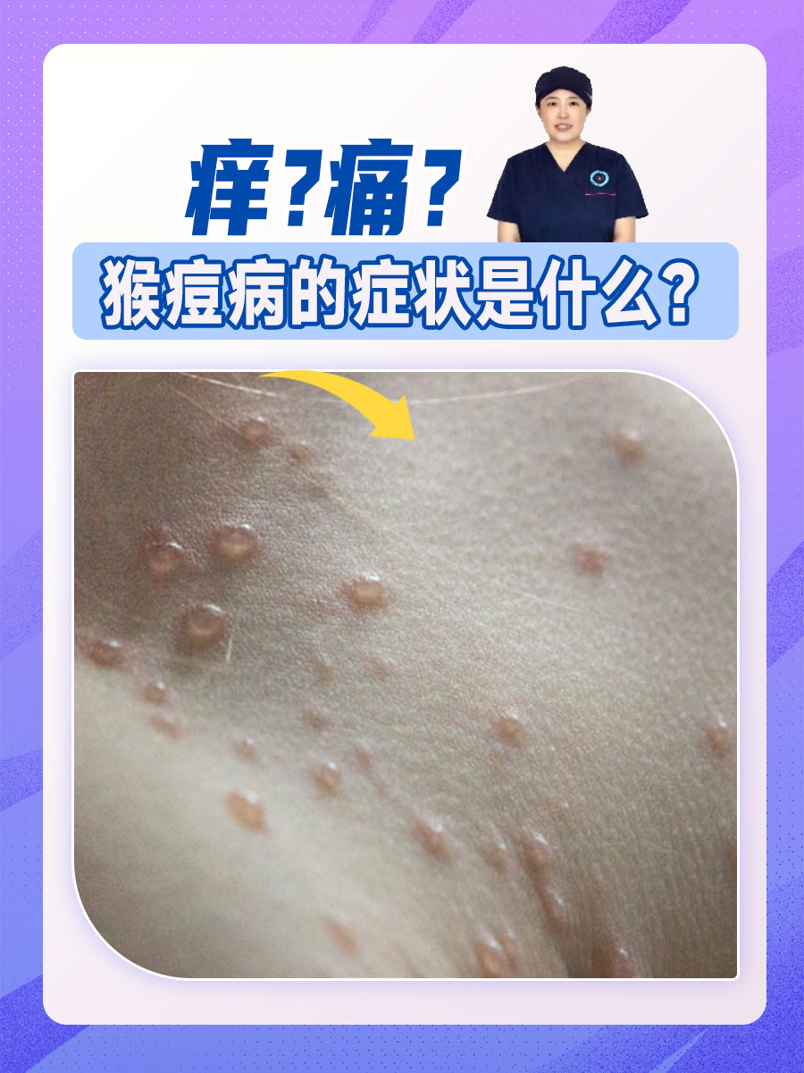痒？痛？猴痘病的症状是什么？
