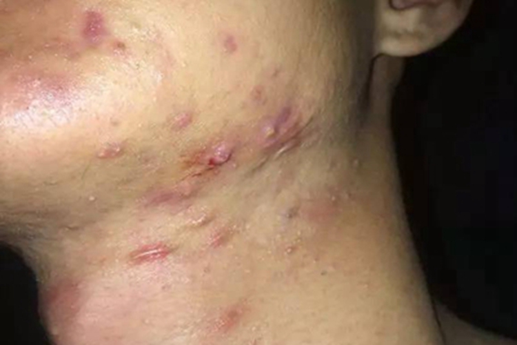 嗜酸性脓疱性毛囊炎下巴结节图