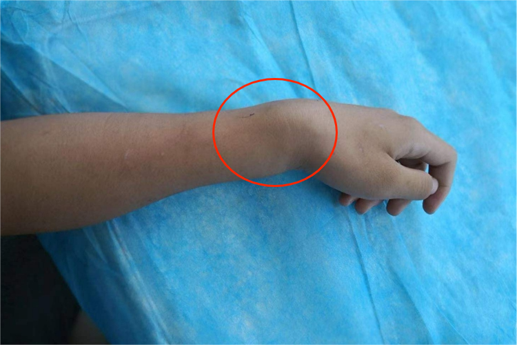 桡骨茎突骨折手腕外侧骨骼突出图