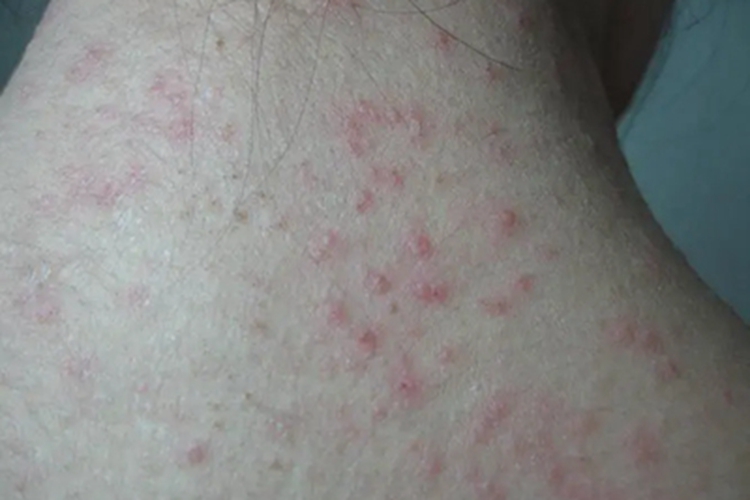 念珠状链杆菌型鼠咬热颈部症状图