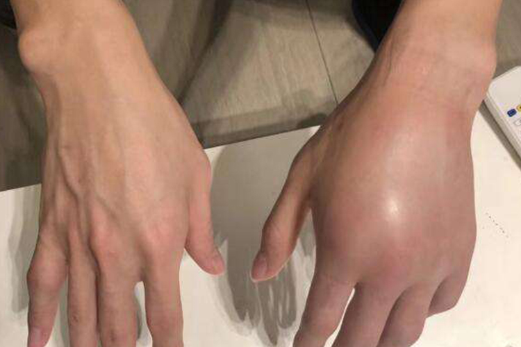 手背骨折肿胀图