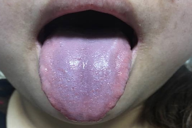 气滞血瘀舌头紫暗图