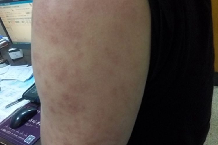 进行性色素性紫癜性皮肤病胳膊图