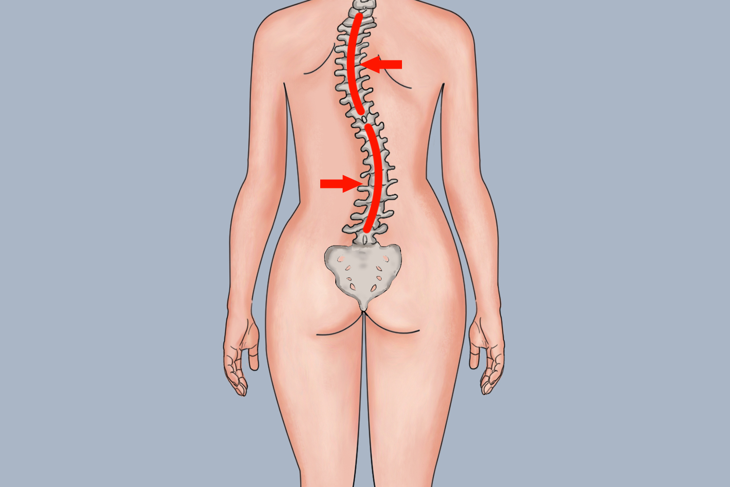 脊柱侧弯“S”型曲线手绘图