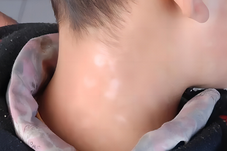 白色糠疹早期症状图 白色糠疹早期症状图