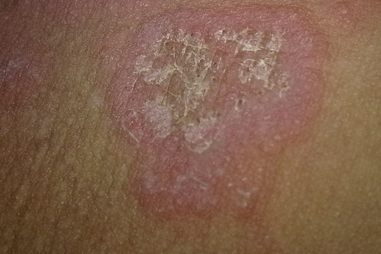 大腿内侧红色扁平湿疣图