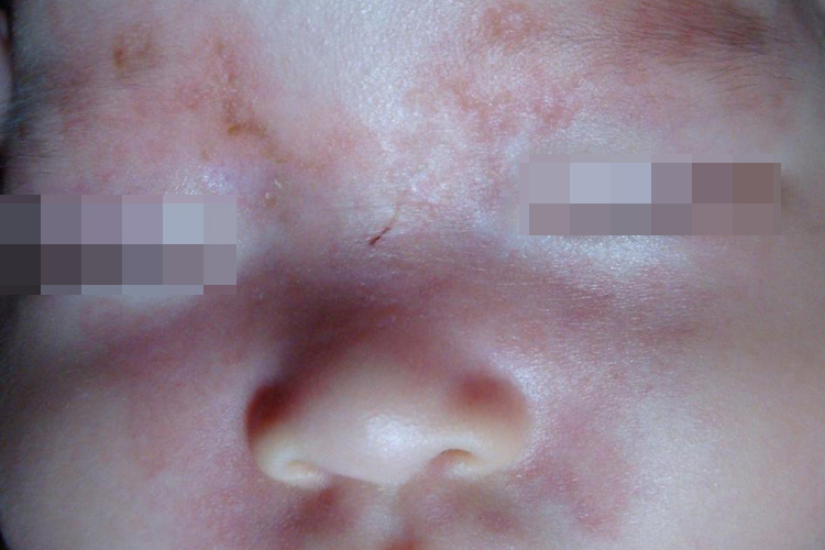 鲜红斑痣早期图