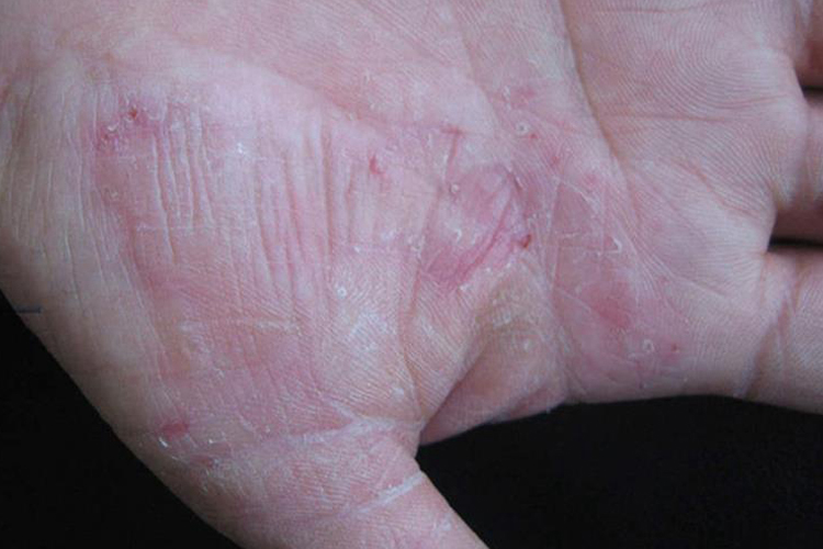 水疱型手癣症状图 水疱型手癣症状图