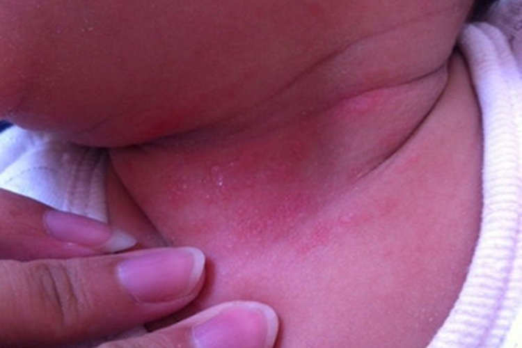 普通型猩红热颈部症状图