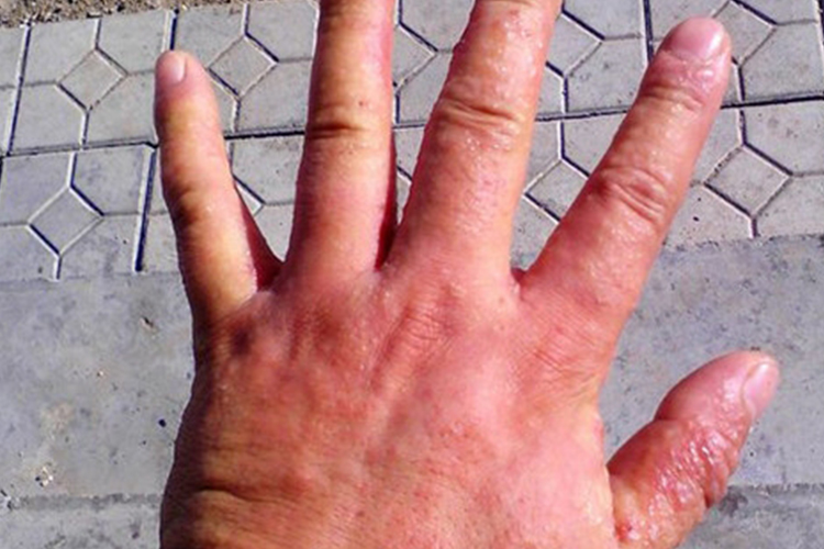 漆树过敏手部红肿图 漆树过敏手部红肿图