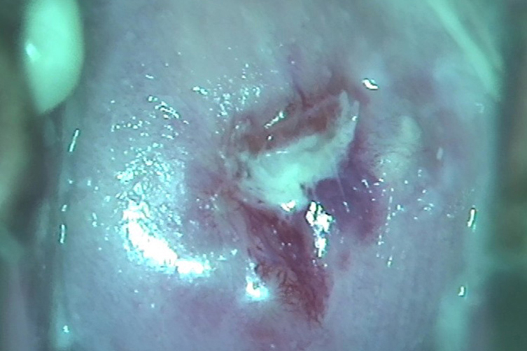 HPV感染黏脓性白带图 HPV感染黏脓性白带图