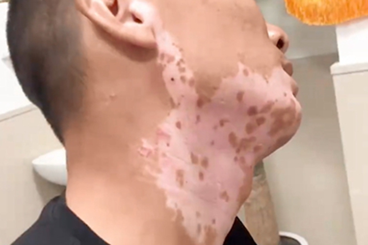 斑状白化病症状图 斑状白化病症状图