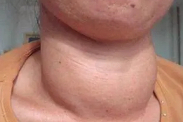 甲状腺囊肿前颈肿块图 甲状腺囊肿前颈肿块图