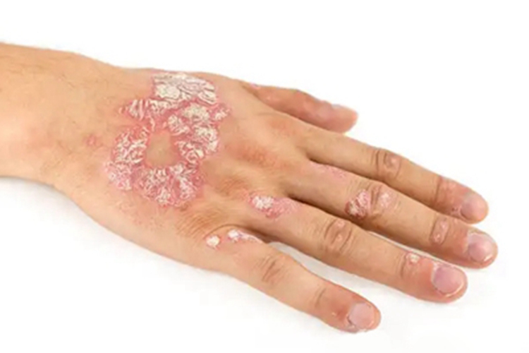 银屑病手背症状图 银屑病手背症状图