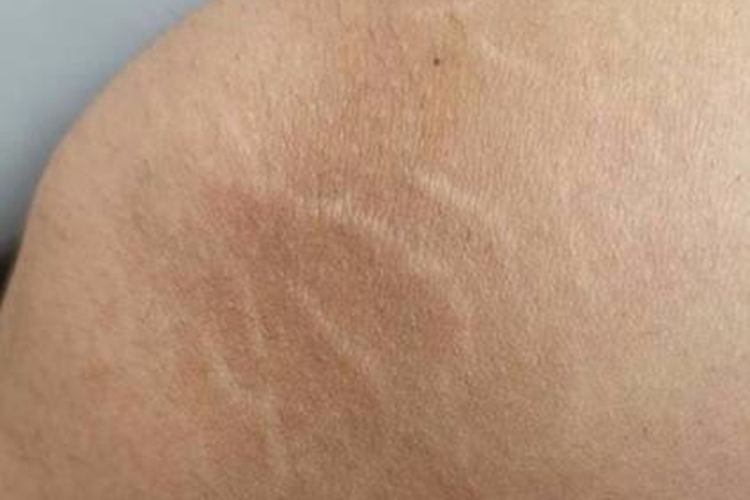 青春期肤色生长纹图