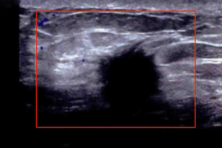 乳腺恶性结节B超图