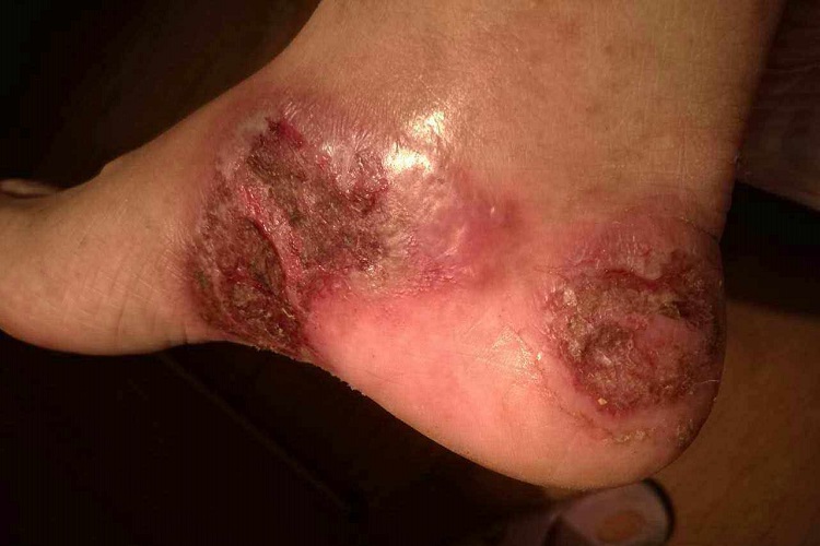 坏疽性臁疮脚部皮肤发紫图