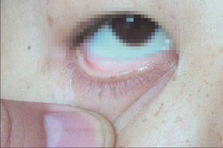 贫血睑结膜图 贫血睑结膜图