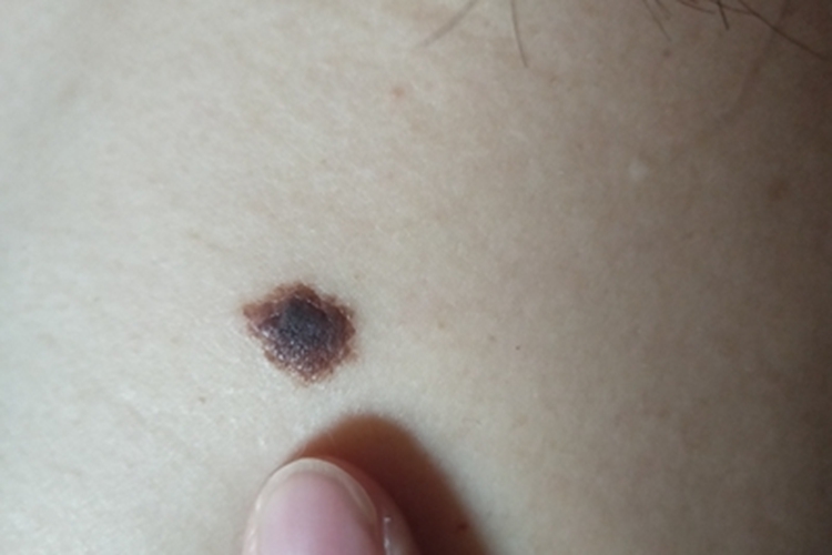 肢端雀斑痣样黑素瘤后颈褐斑图