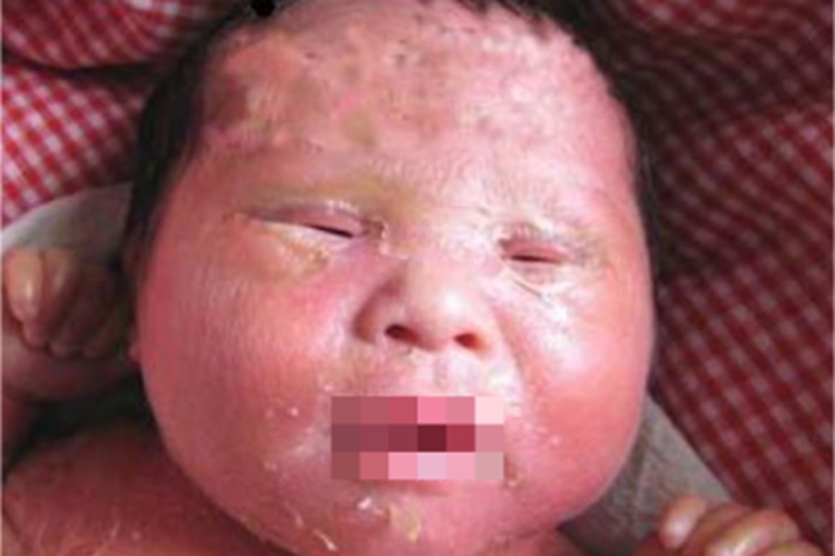 先天性外胚叶发育不良面部脱皮图