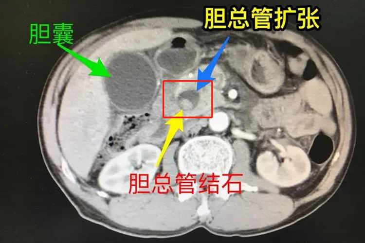 胆总管结石CT“新月征”图