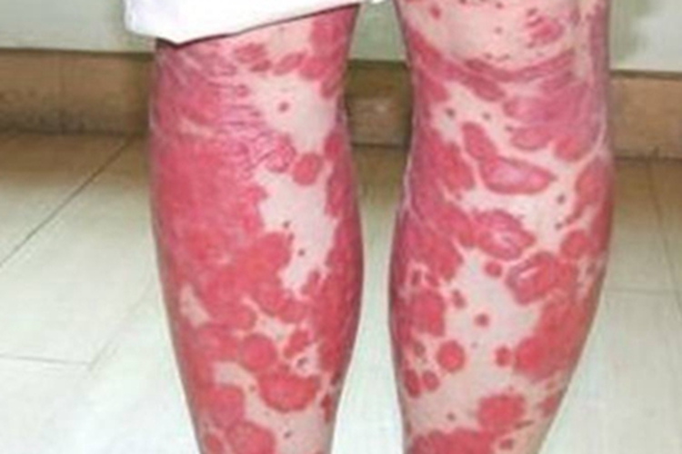 红皮型银屑病初期图