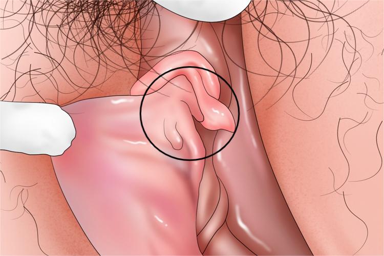 女性尖锐湿疣早期图