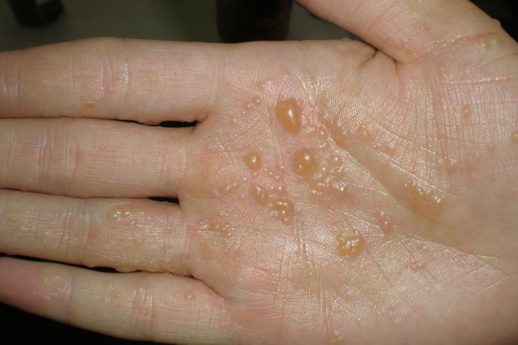 水疱型手癣图