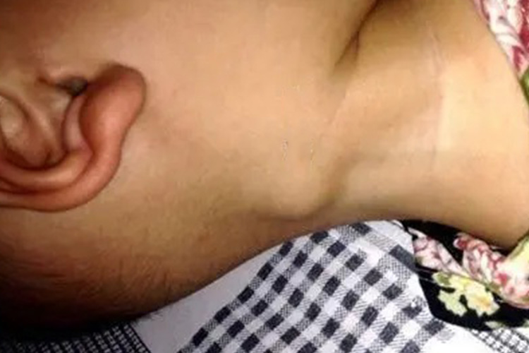 颈部淋巴结肿大图