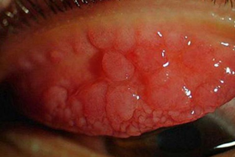 进行期沙眼眼睑小疙瘩图 进行期沙眼眼睑小疙瘩图