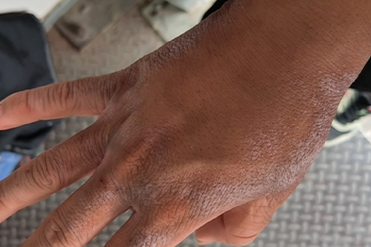 窝状角质松解症皮肤颜色变浅图 窝状角质松解症皮肤颜色变浅图