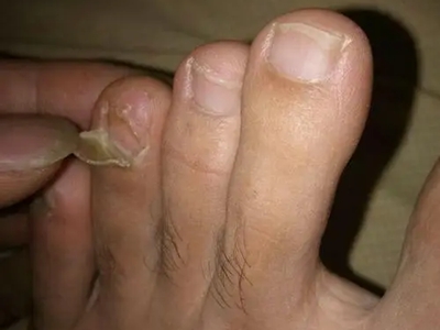 甲营养不良脚趾甲变薄缺损图.jpg