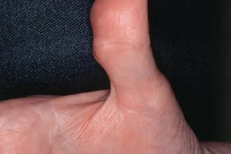手指早期类风湿结节图