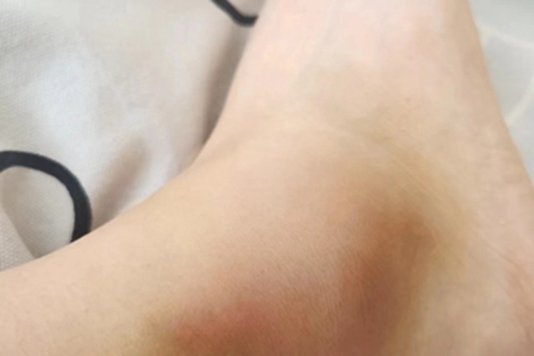 踝扭伤脚踝局部发红肿胀图 踝扭伤脚踝局部发红肿胀图