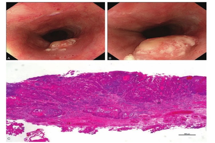 食道鳞状细胞癌图