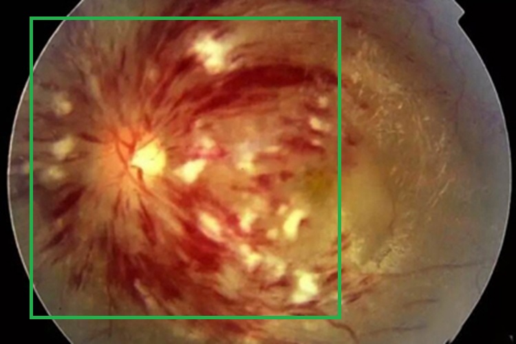 恶性高血压视网膜病变视网膜斑图 恶性高血压视网膜病变视网膜斑图