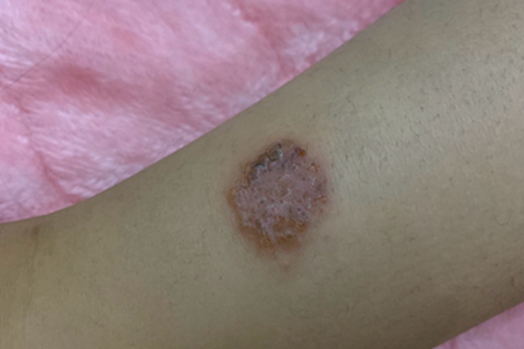 慢性湿疹胳膊脱皮图