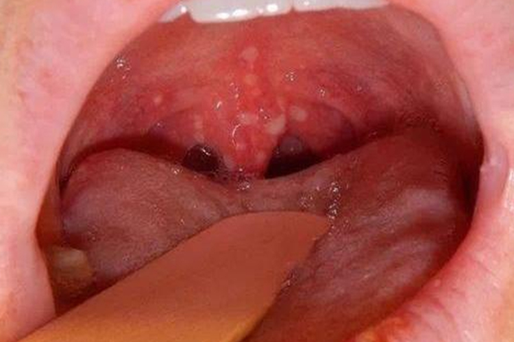 疱疹性咽炎图